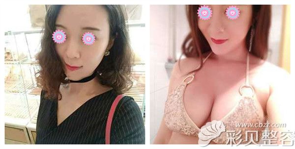 张清峰医生自体脂肪丰胸术后真实案例对比照