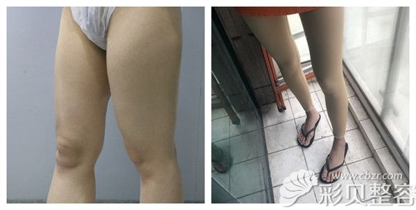 北京南加美容门诊张清峰腿部吸脂塑形术后21天对比案例