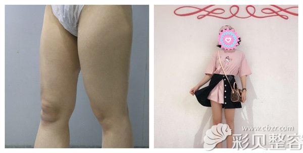 北京南加整形美容医院张清峰医生腿部吸脂术后案例对比