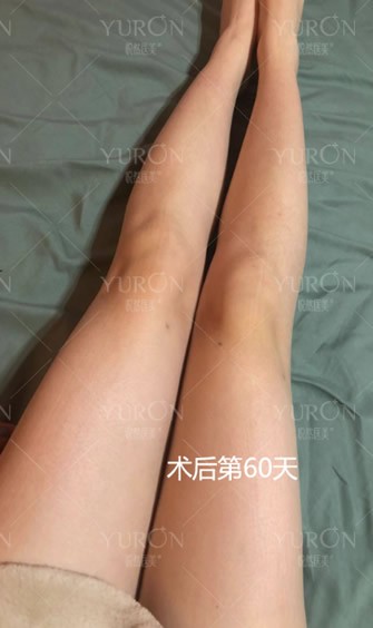 北京悦然医美李京霖吸脂案例 看我大腿吸脂2000cc后瘦了多少