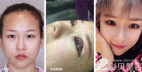 北京悦然整形美容医院张敏燕院长双眼皮失败修复案例