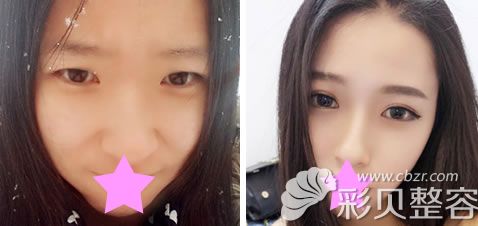 肖育亮全切双眼皮+鼻综合效果对比图