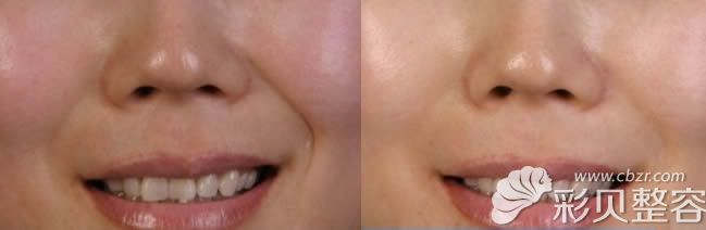 鼻唇沟治疗前后对比图