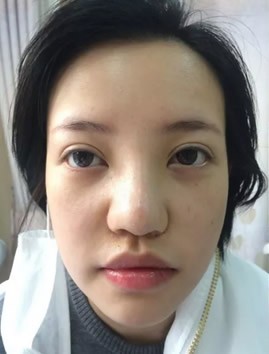玻尿酸隆鼻不好看 我就找上海丽质卢九宁做了假体隆鼻手术