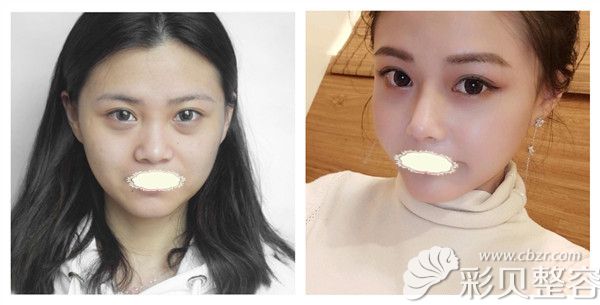 衡阳雅美医疗美容医院廖伟龙医生硅胶隆鼻真实术后案例对比图展示