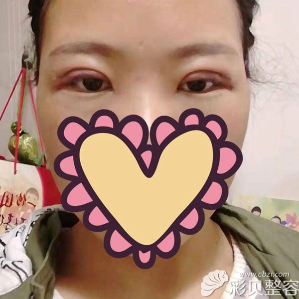 西安高一生刘军为我割双眼皮手术第3天照片