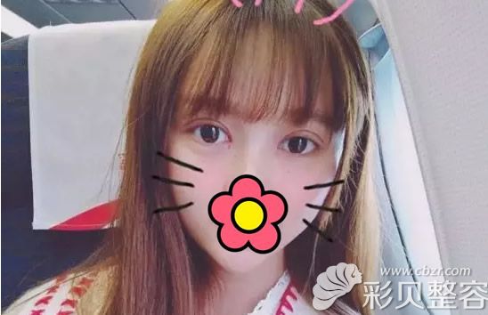 西安壹加壹美容医院全切双眼皮+开眼角一个月恢复效果 西安壹加壹美容医院全切双眼皮+开眼角一个月恢复效果