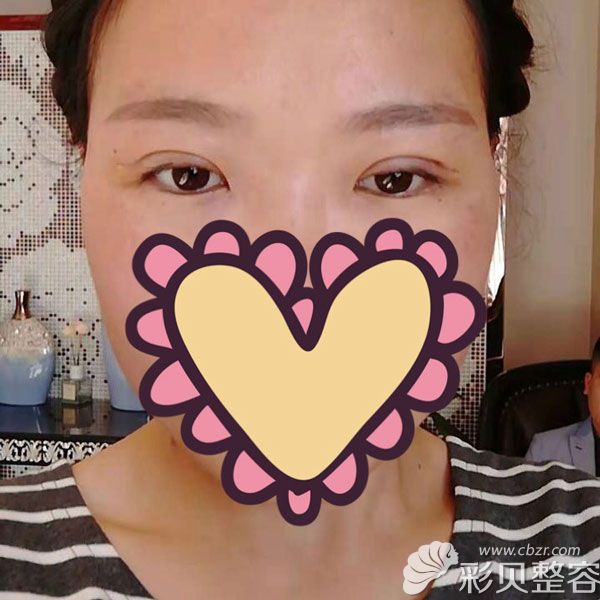 西安高一生刘军为我割双眼皮术后第10天效果给多大家看
