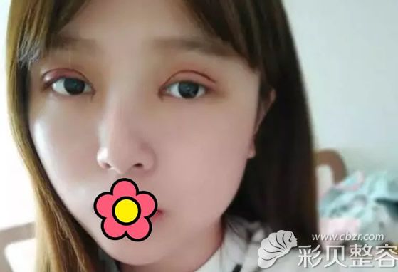 全切双眼皮+开眼角第二天 全切双眼皮+开眼角第二天