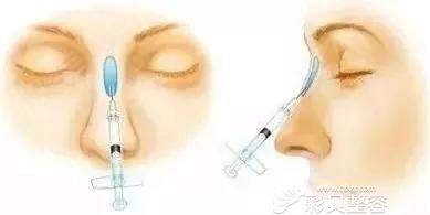 玻尿酸隆鼻注射部位