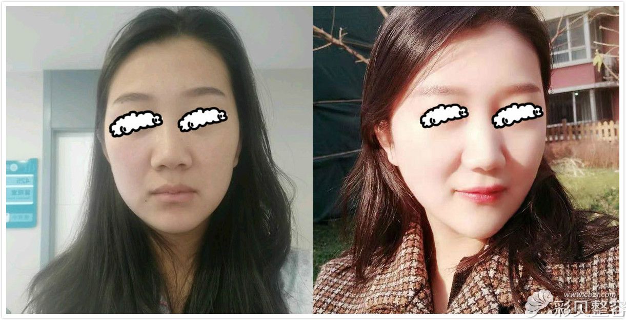 聊城韩美倪景辉给我做脸部线雕40天前后对比效果图