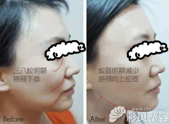聊城韩美脸部线雕提升案例效果对比图