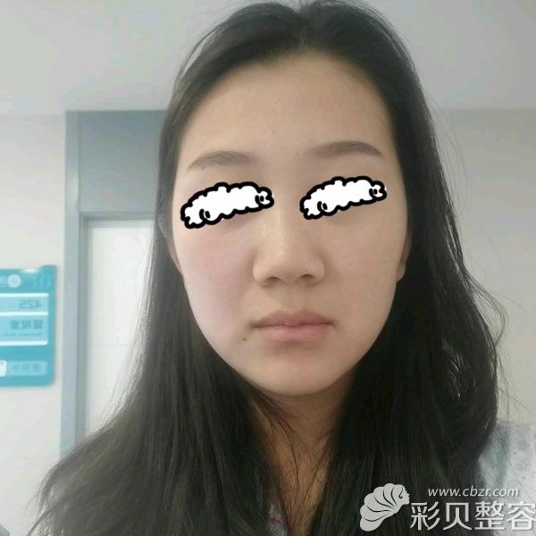 我没去聊城韩美整形医院做脸部线雕前照片