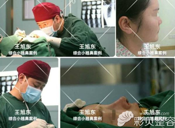 王旭东医生正在进行综合小翘鼻隆鼻手术