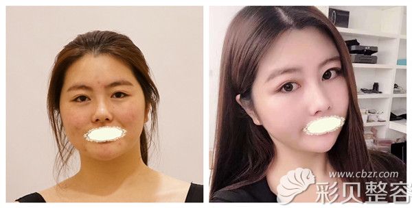 韦婷医生全面部线雕术后20天效果展示案例