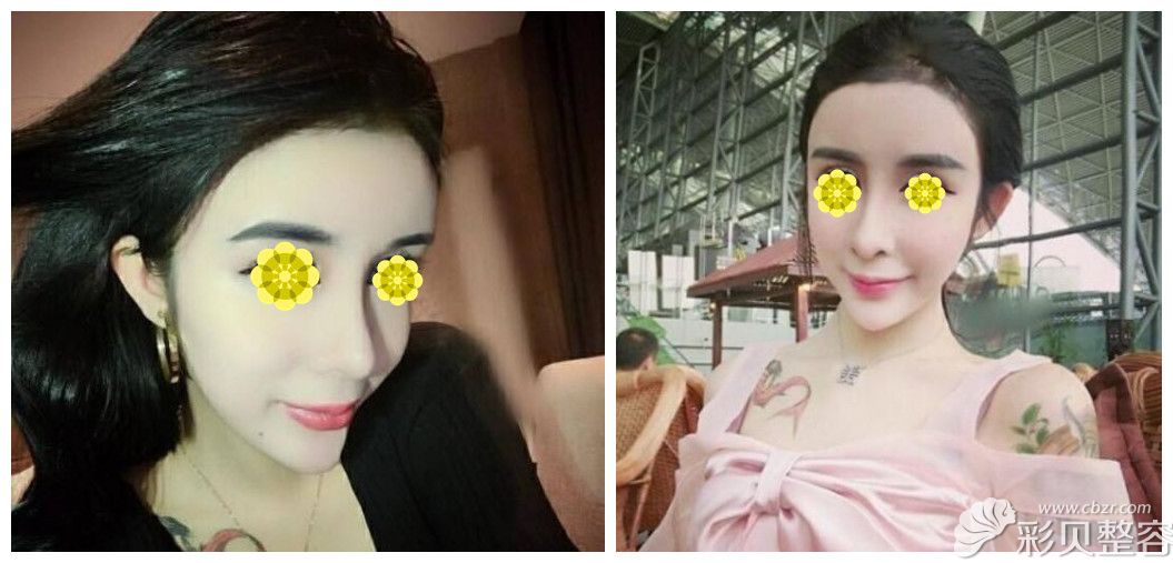 整容后“蛇精脸” 整容后“蛇精脸”