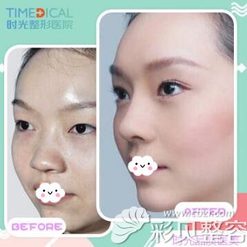 兰州时光整形医院双眼皮案例效果对前后对比图