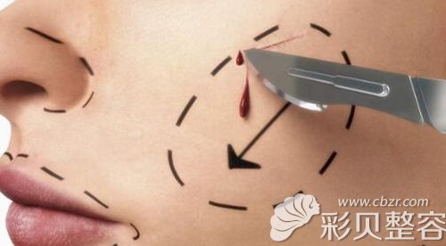 整形手术的方法