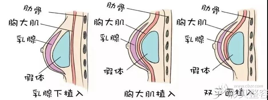 假体隆胸的植入方法展示