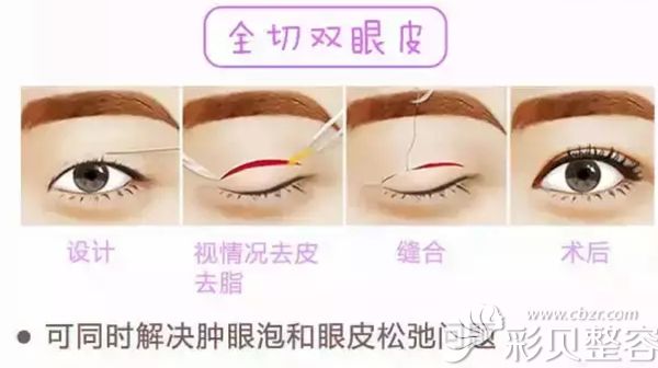 上海仁爱全切双眼皮手术过程