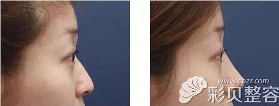 张哲医生鼻综合对比案例 张哲医生鼻综合对比案例