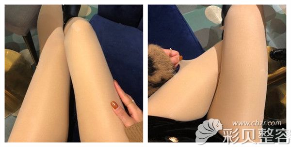 武汉华美刘光伟院长做腿部吸脂塑形术后100天展示案例图