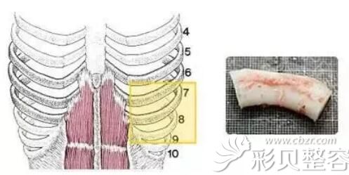 肋软骨隆鼻材料 肋软骨隆鼻材料
