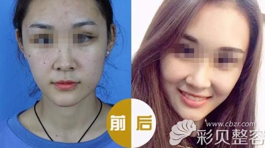 柏丽张继平展示皮秒效果