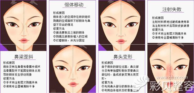 常见的隆鼻失败需要修复的情况 常见的隆鼻失败需要修复的情况