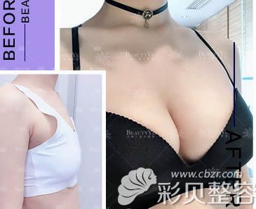 北京叶美人整形假体隆胸案例效果对比图