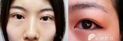 左边是眼皮有肉条感，右边是眼皮浮肿