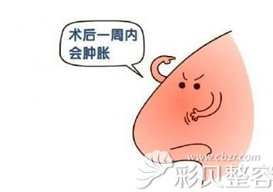 张哲医生讲隆鼻术后一周内肿胀都是正常的 张哲医生讲隆鼻术后一周内肿胀都是正常的