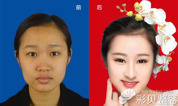 柳州美丽焦点割双眼皮+自体软骨综合隆鼻效果案例