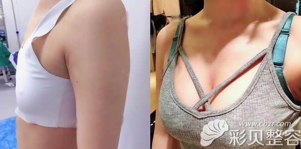 北京叶美人姚明龙自体脂肪隆胸效果对比图