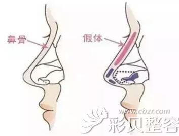 张哲医生讲什么是假体隆鼻