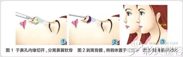 张哲医生给出假体隆鼻原理 张哲医生给出假体隆鼻原理