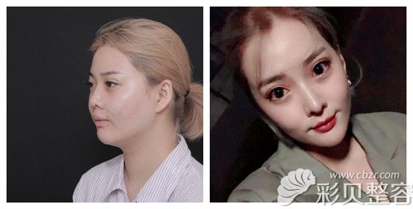 北京沃尔赵丹耳软骨垫鼻尖、鼻综合隆鼻案例