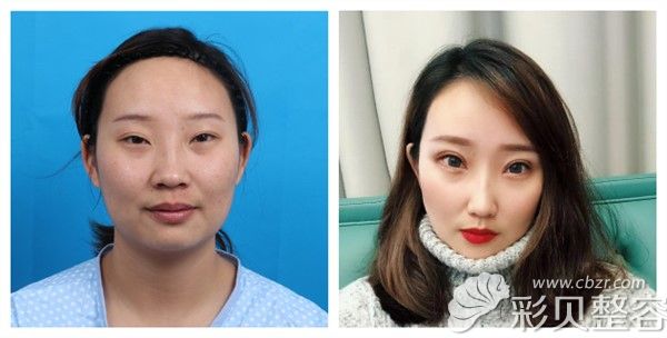 常州美莱赵春飞双眼皮失败修复，做韩式微创眼综合术后15天案例对比展示