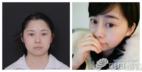 北京沃尔赵丹硅胶隆鼻真实术后对比照展示图