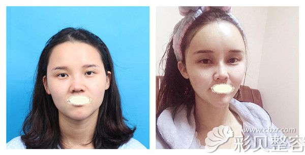 常州美莱李智勇主任自体脂肪面部填充术后效果对比图
