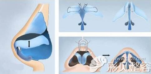 张哲医生分享鼻宽矫正原理 张哲医生分享鼻宽矫正原理