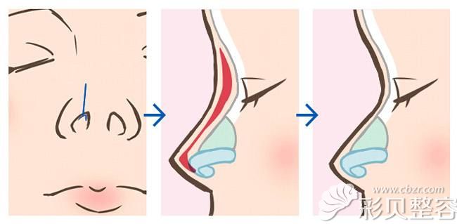 张哲分享隆鼻能垫高几毫米 张哲分享隆鼻能垫高几毫米