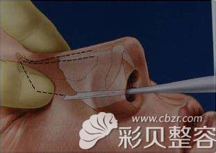 张哲医生解答鼻骨缩窄术 张哲医生解答鼻骨缩窄术