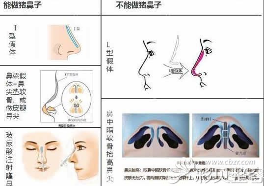 关于哪种隆鼻方式术后可以做猪鼻子动作的介绍