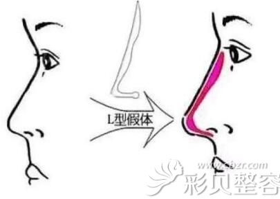 隆鼻医生张哲给出假体隆鼻原理 隆鼻医生张哲给出假体隆鼻原理