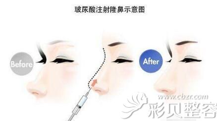 张哲分享玻尿酸注射隆鼻原理 张哲分享玻尿酸注射隆鼻原理