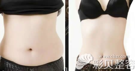 北京伊莱美整形黄元生做腰腹部吸脂案例效果对比图