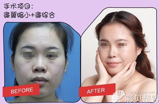 南京鼻祖隆鼻前后对比案例 南京鼻祖隆鼻前后对比案例
