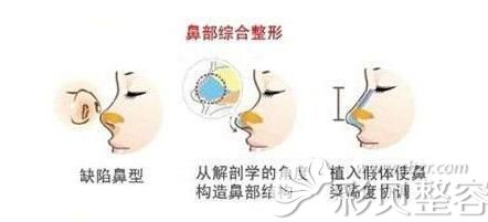 张哲分享鼻子综合整形手术原理 张哲分享鼻子综合整形手术原理