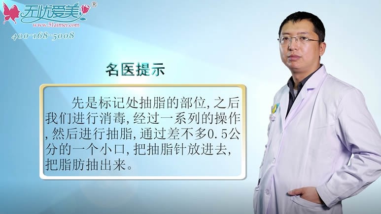 什么是吸脂减肥手术?北京海医悦美李广学脂肪移植医生解答